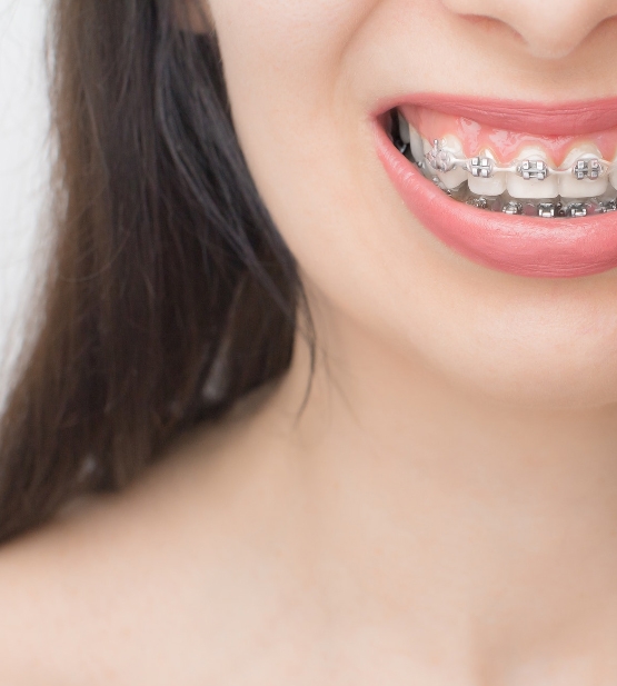Corrige tu sonrisa con brackets tradicionales o alineadores invisibles. Tratamientos personalizados para niños y adultos. ¡Transforma tu sonrisa!